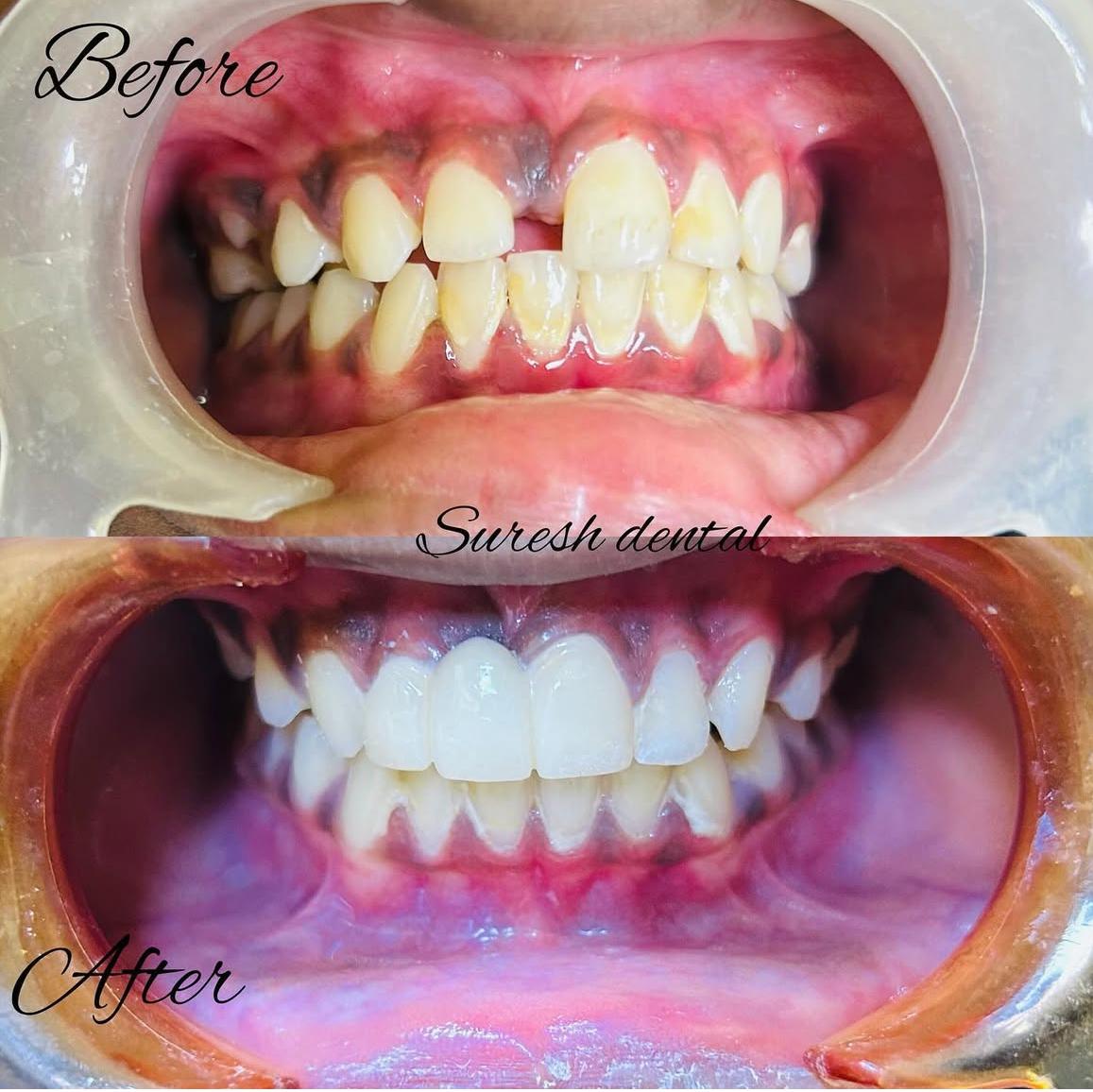 Smile Makeover