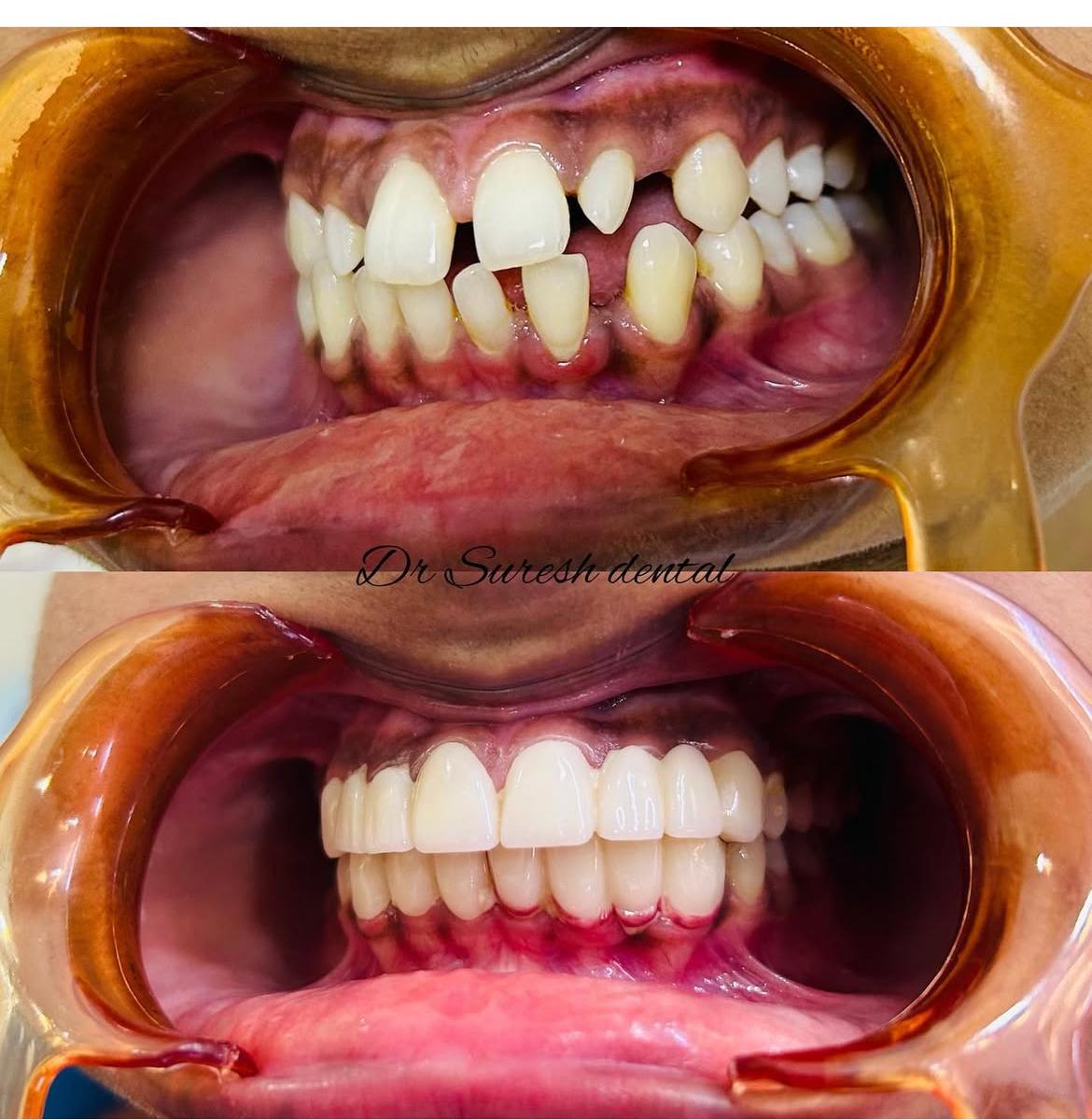 Orthodontic Treatment